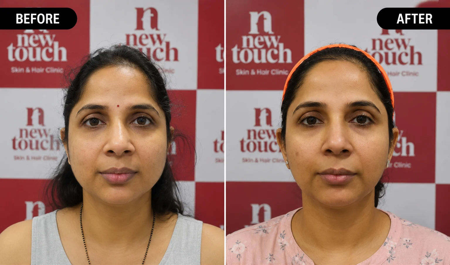new-touch treatment results