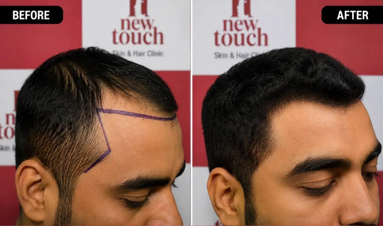 Before and after treatment