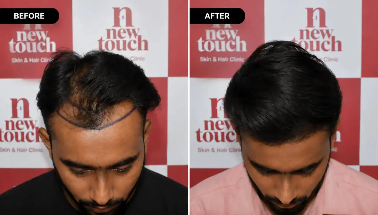 Before and after treatment