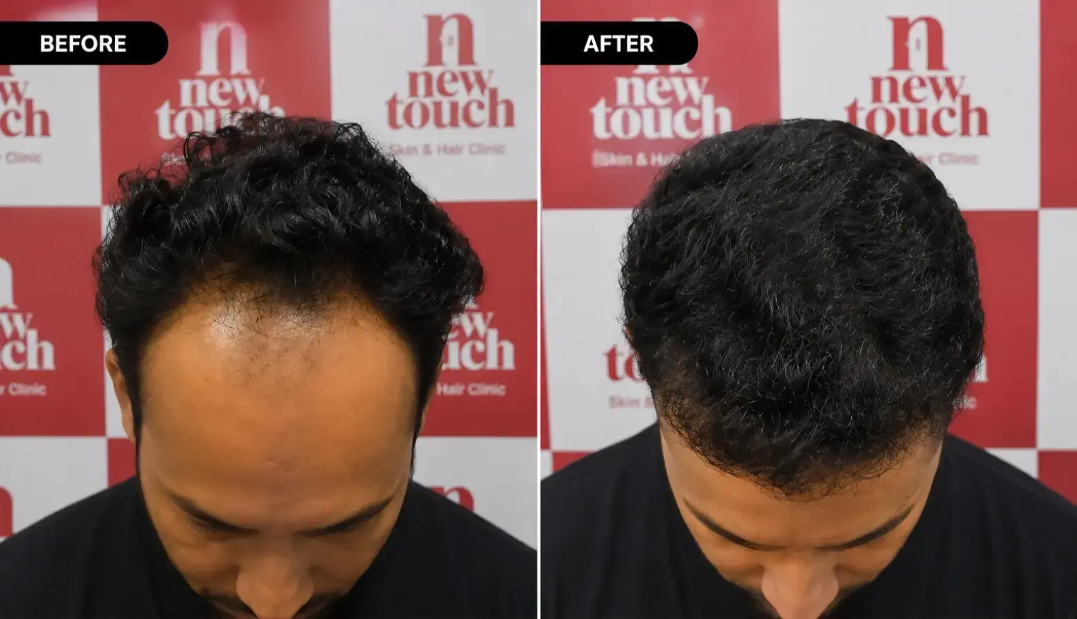 Before and after treatment