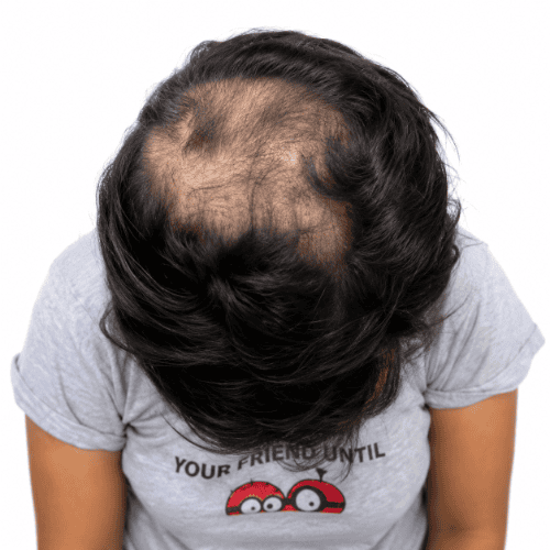 Treatment Results